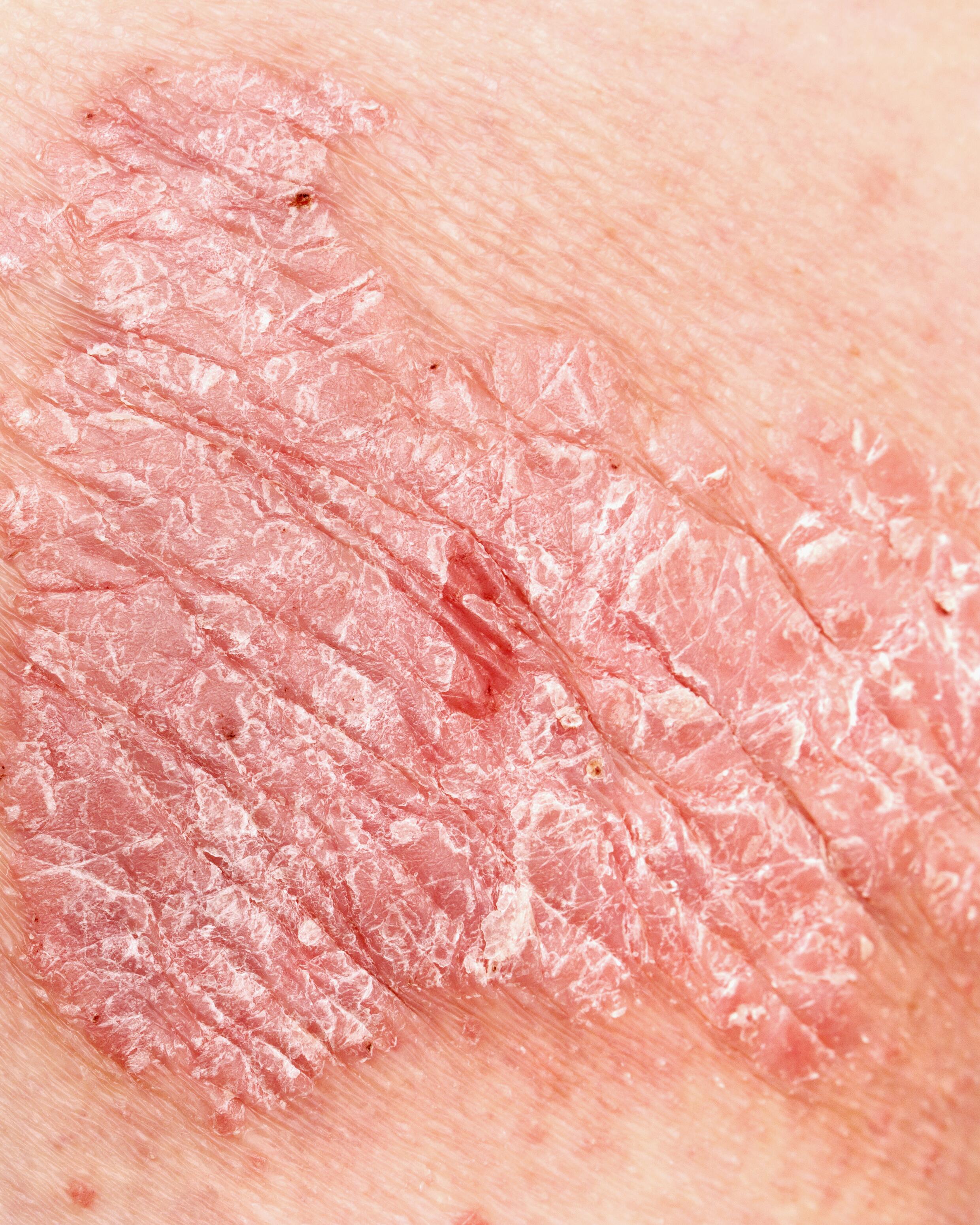 av_eczema-psoriasis_psoriasis_close-up_1x1 368x460