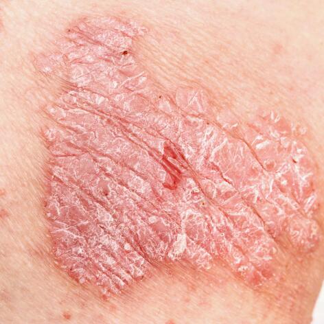 av_eczema-psoriasis_psoriasis_close-up_1x1 472x472
