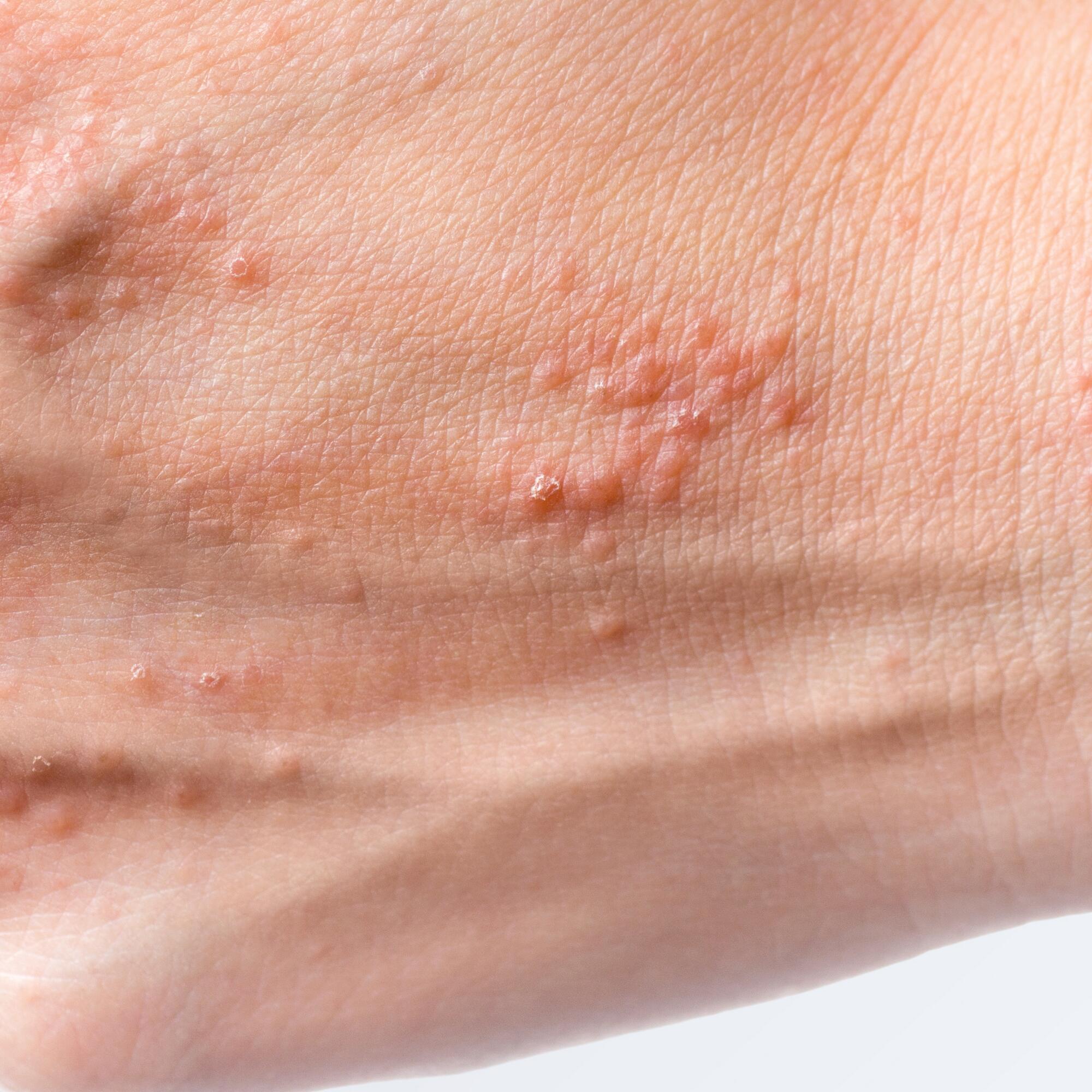 av_eczema-psoriasis_main_dyshidrose_1x1