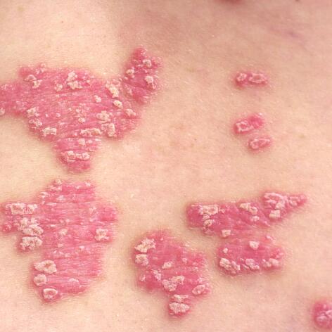 av_eczema-psoriasis_plaques-rouges_1x1 472x472