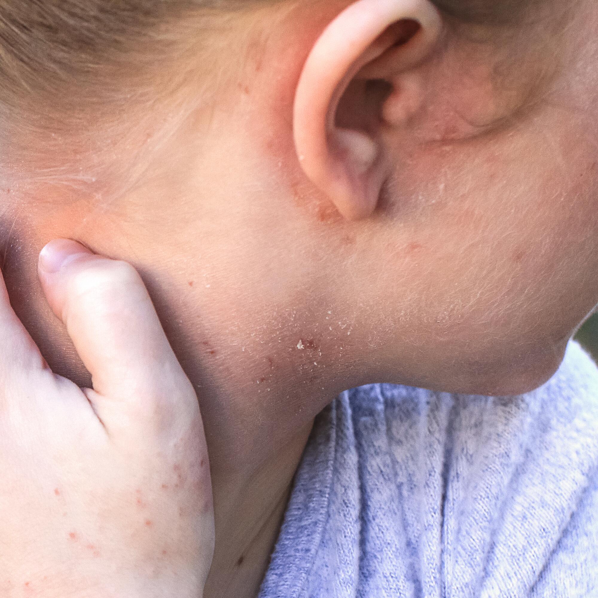 av_eczema-psoriasis_oreilles_1x1