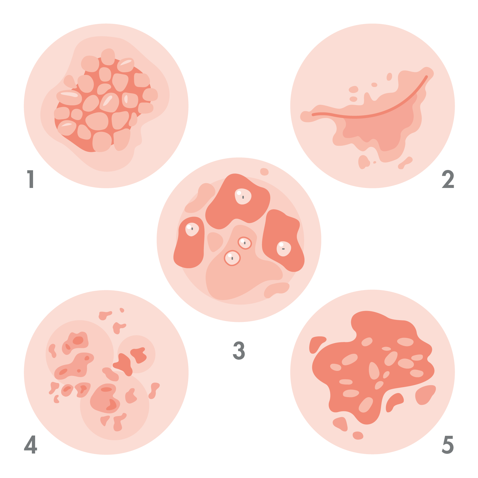 av_eczema-psoriasis_schema_types-de-psoriasis_1x1