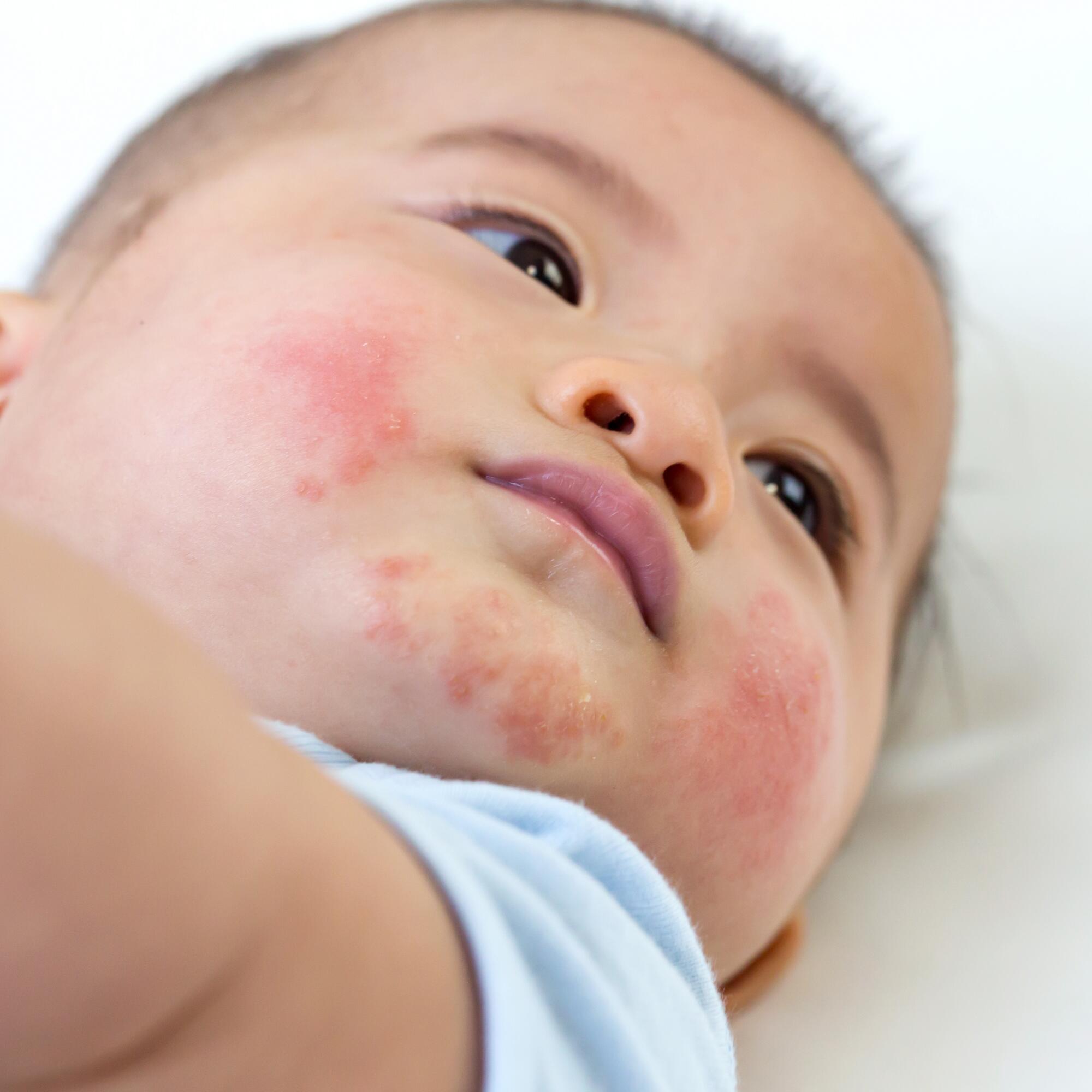Eczema en bebés