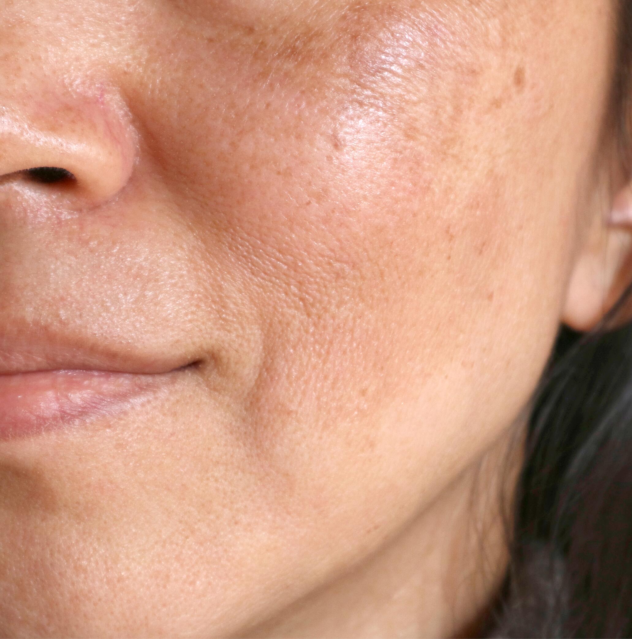 Sunspots on Face: Causes, Treatments, Prevention and Skin Cancer