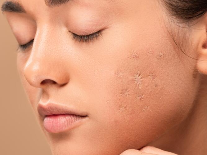 Tout savoir sur les cicatrices du visage