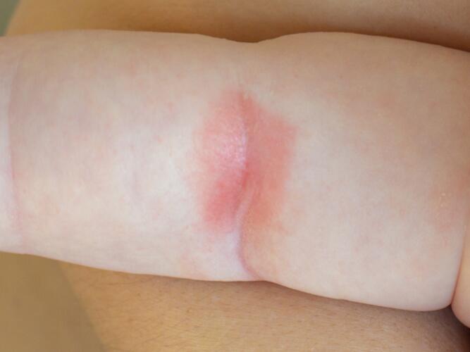 Intertrigine: cause, sintomi e trattamento