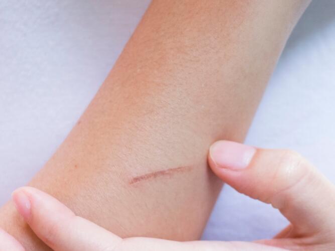 Cicatrices et vergetures