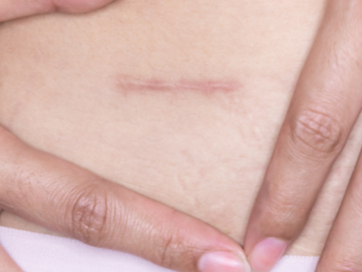 Cicatrices et vergetures