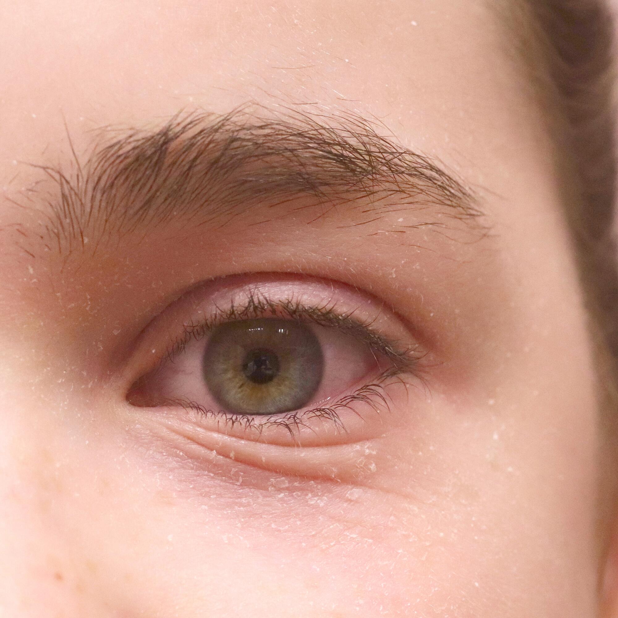 eczema-atopique-ou-paupieres