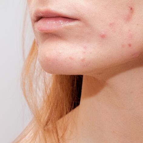 L'acné chez la femme adulte : causes, soins et traitements