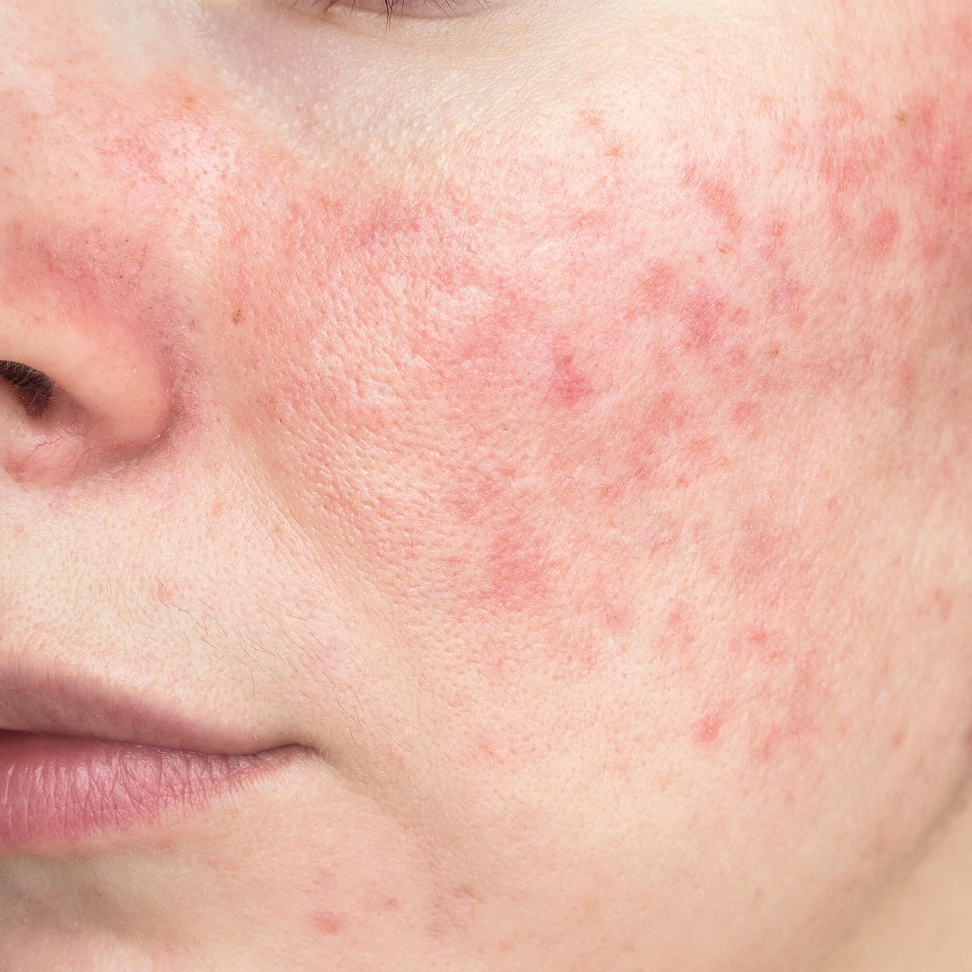 av_peaux-sensibles_acne_papulo-pustuleuse_rosacee 472x472