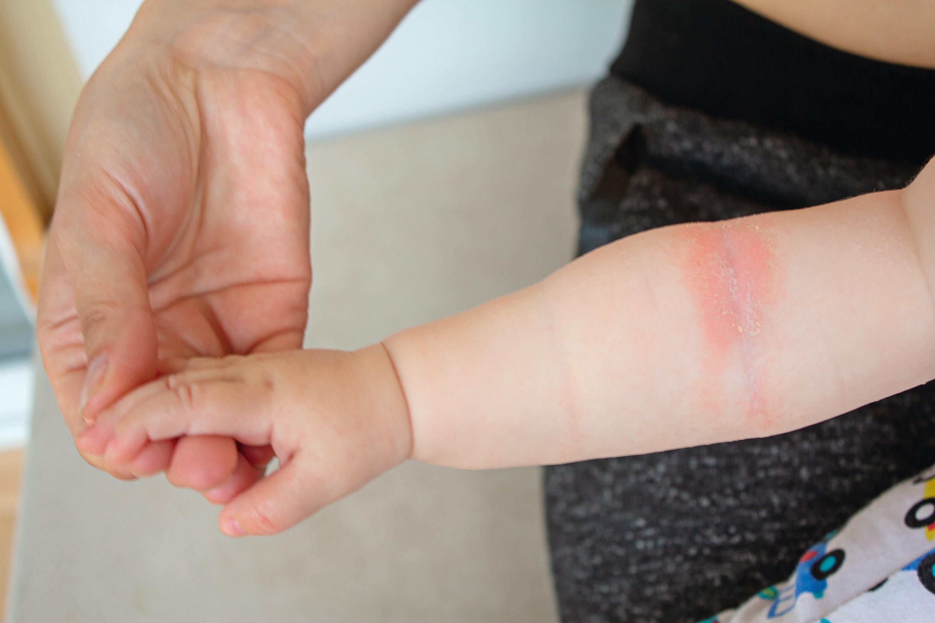 AD_ATOPIE_BABY-ARM_LARGE_2021