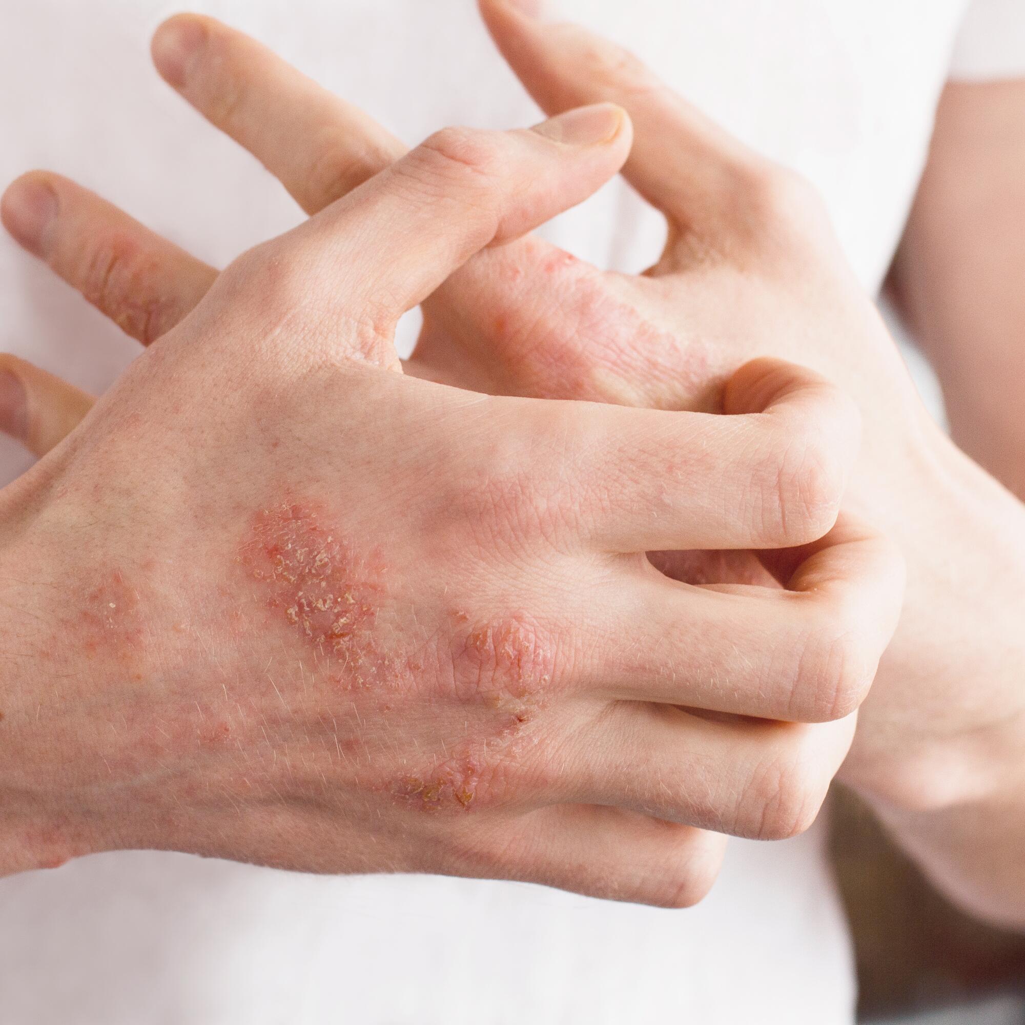 Eczema de manos y pies