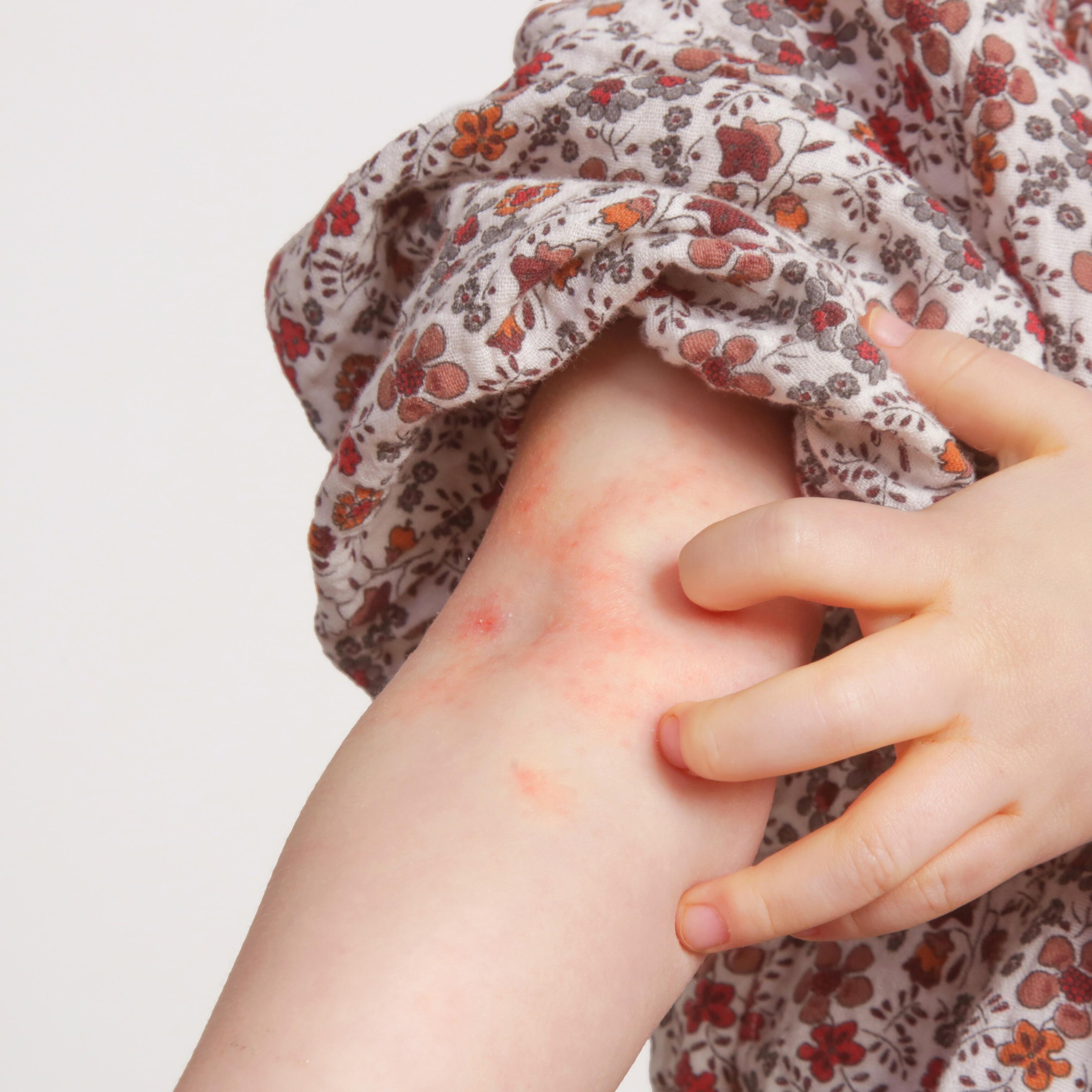 av_eczema-psoriasis_enfant_interieur-coude_1x1