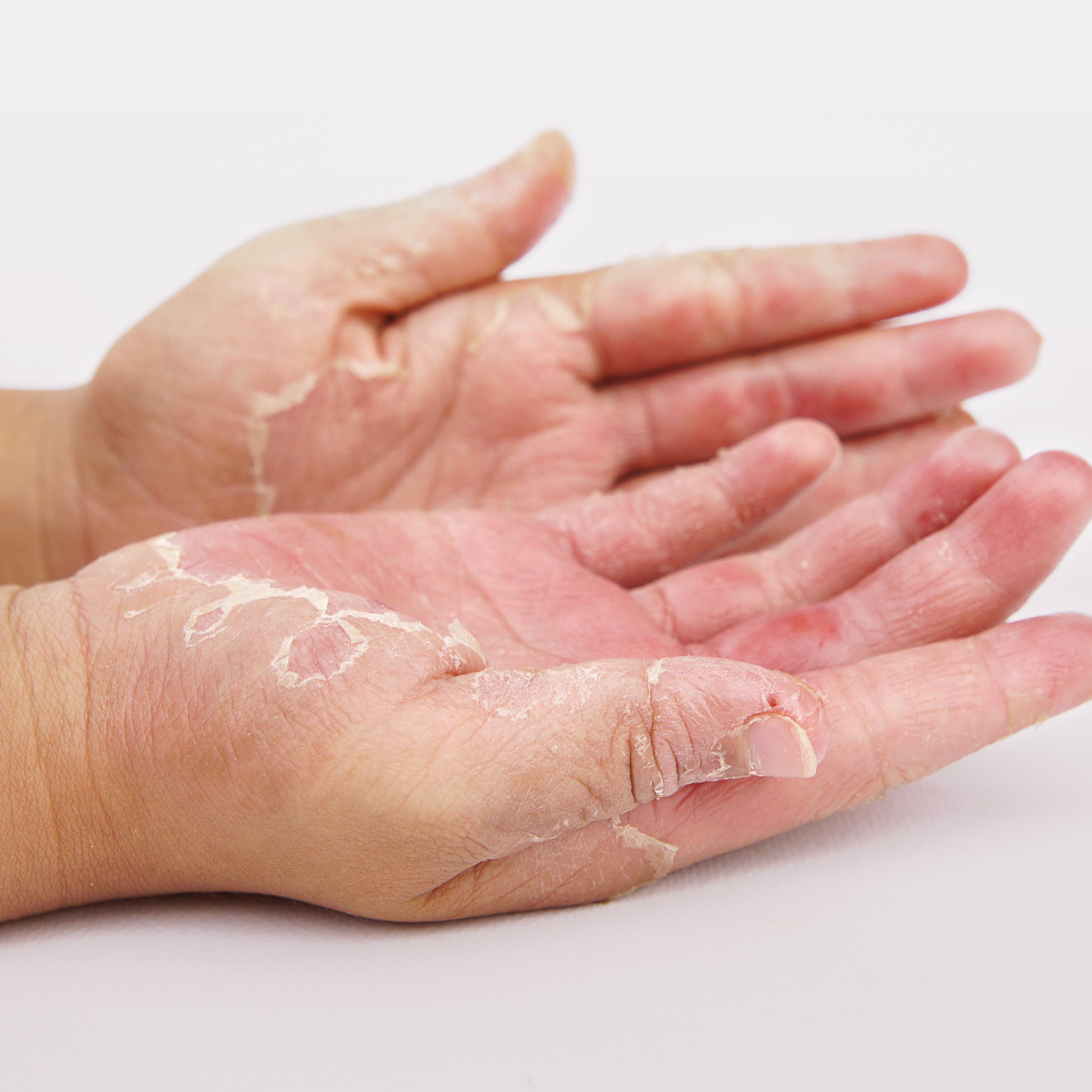 av_eczema-psoriasis_mains_bras_1x1