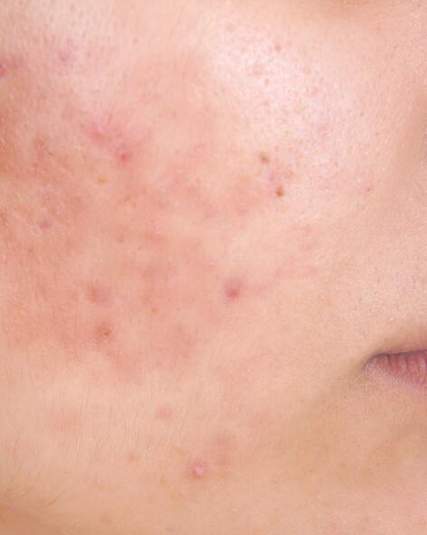 L'acné inflammatoire