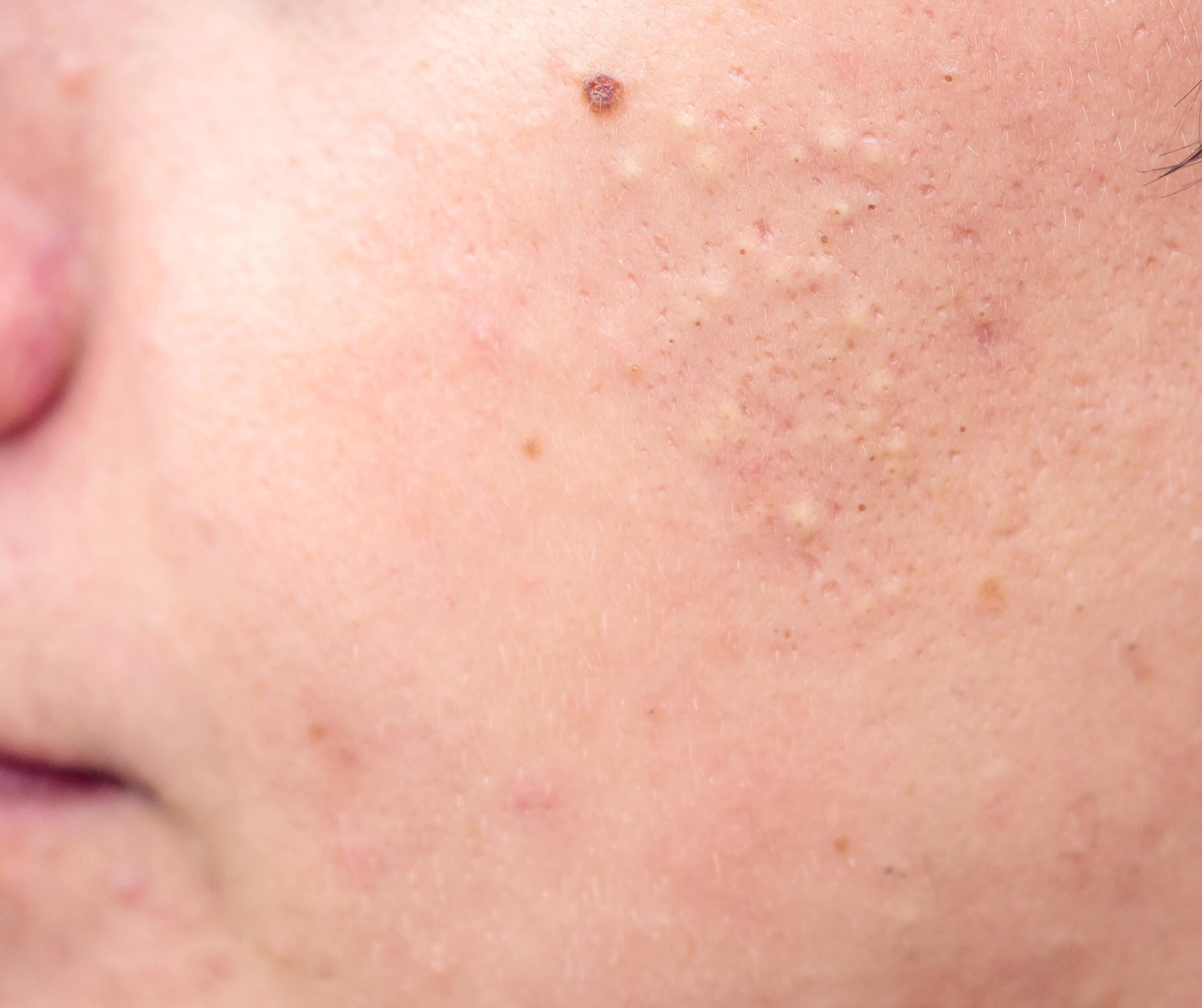 Dosering Niet genoeg Hoofdstraat Vette huid en acne, oorzaken, gevolgen en oplossingen | Thermaal Water van  Avène