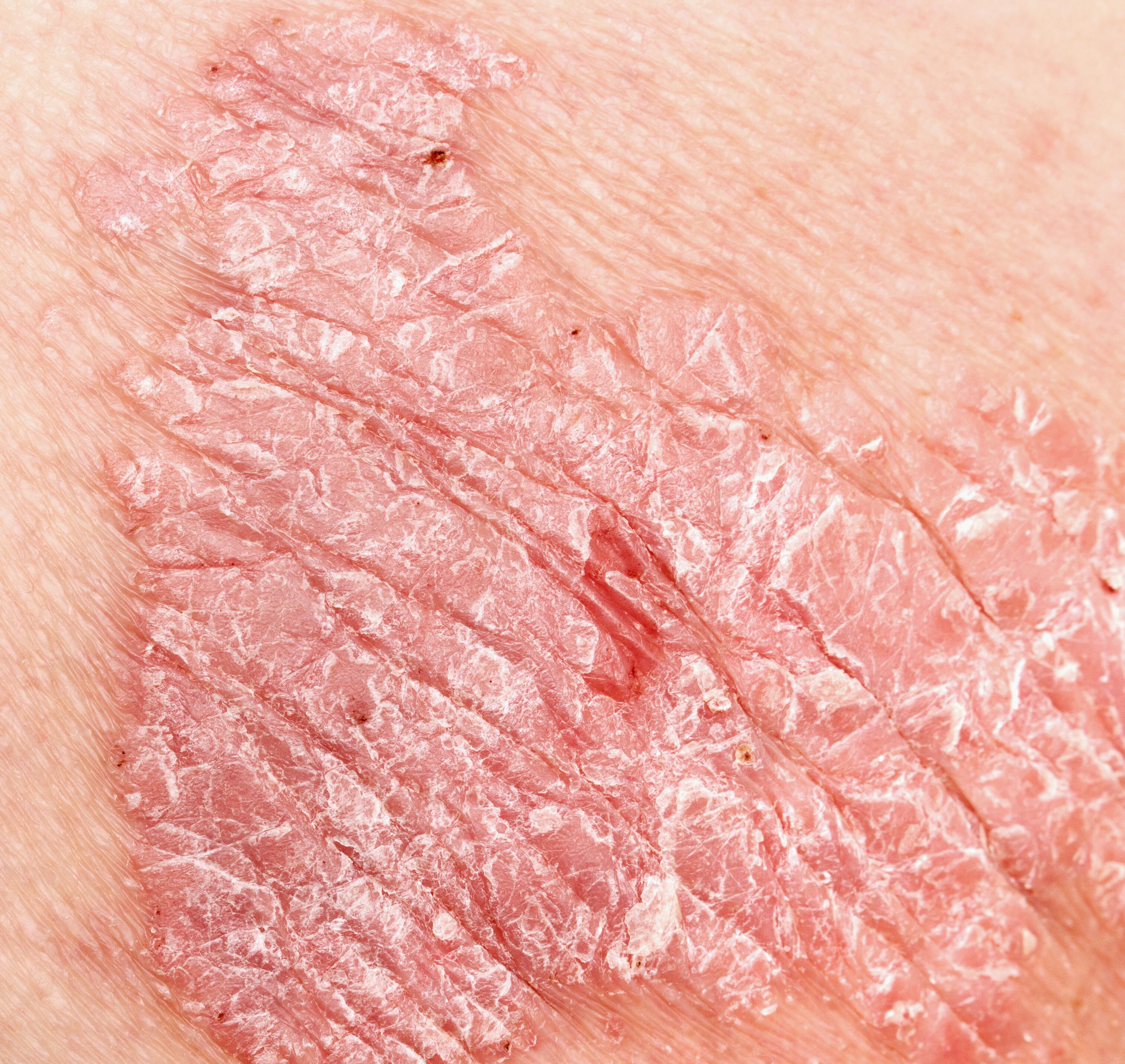 av_eczema-psoriasis_maquillage-medical_1x1