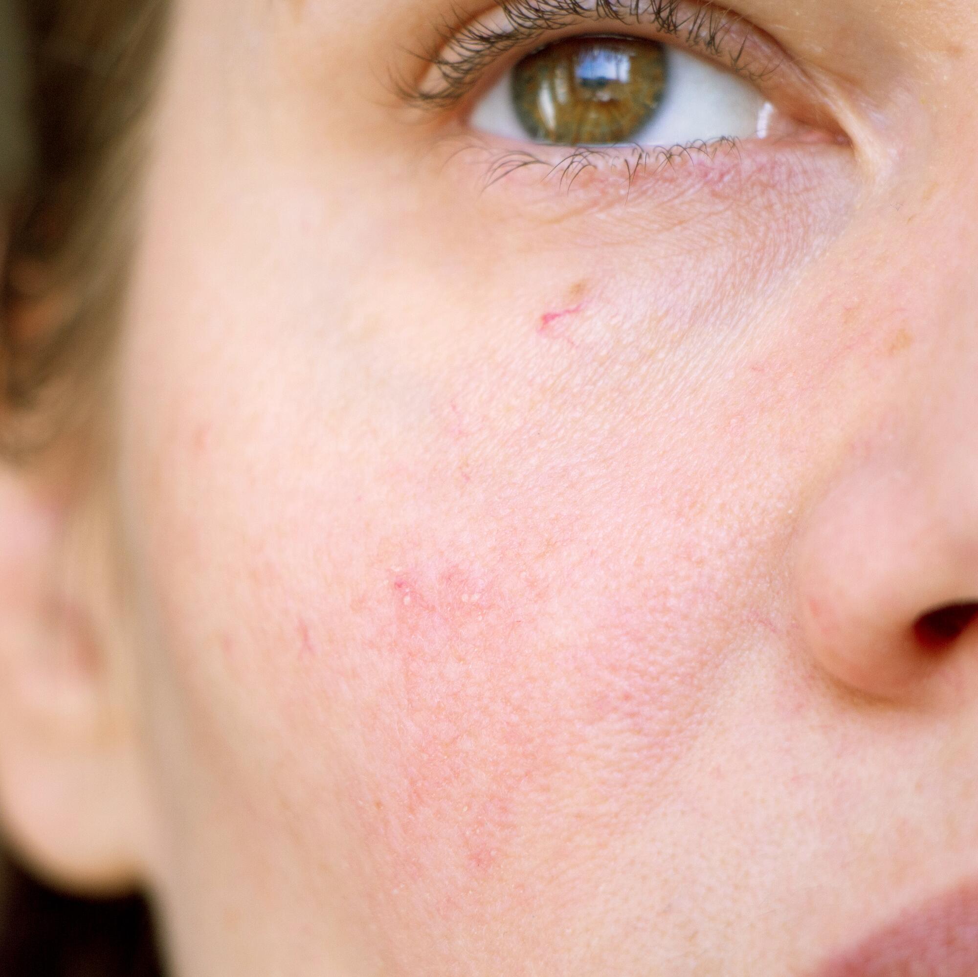 av_peaux-sensibles_couperose_1x1