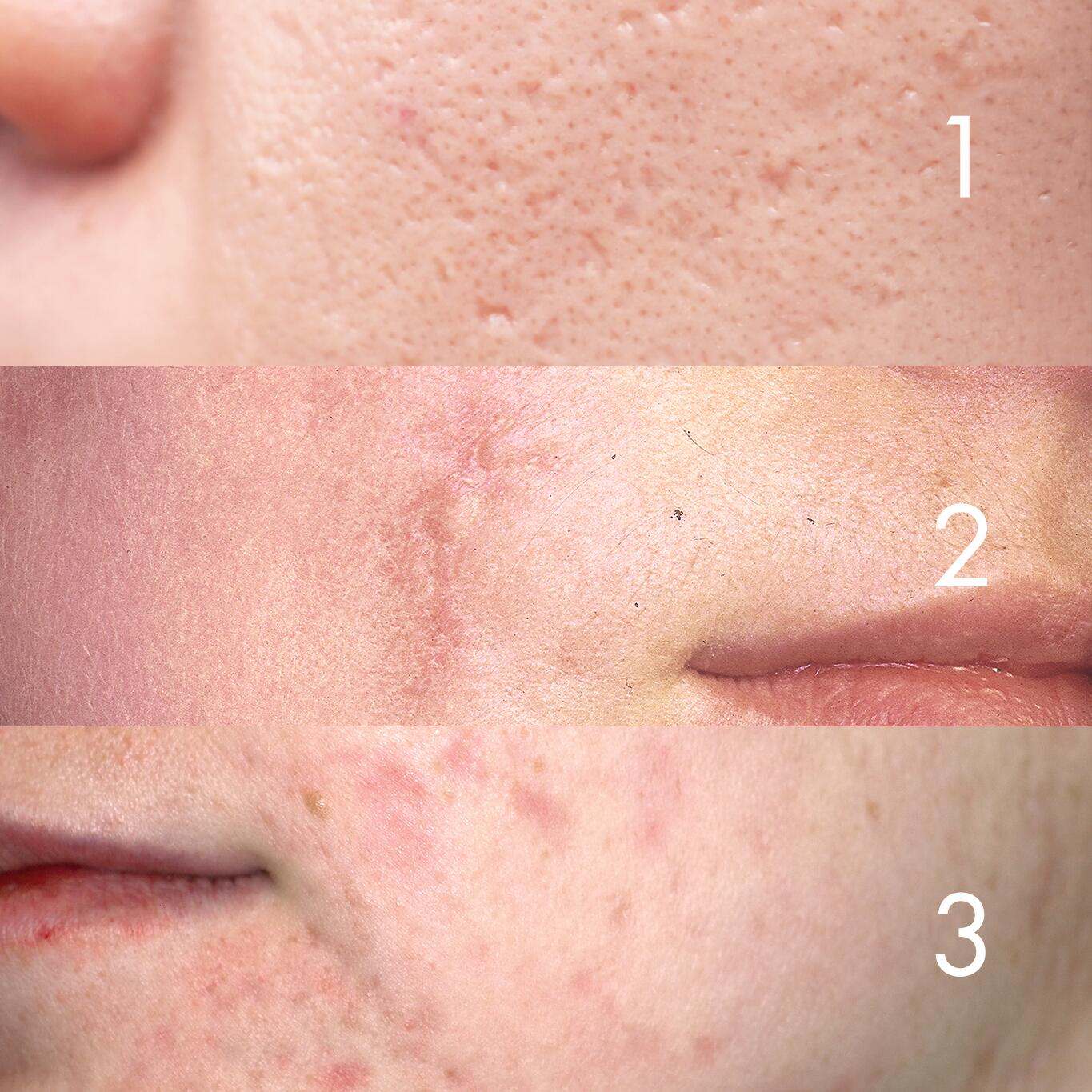 Comprendre et atténuer les cicatrices d'acné |Avène