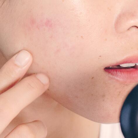 Soluții specifice pentru a reduce cicatricile post-acneice