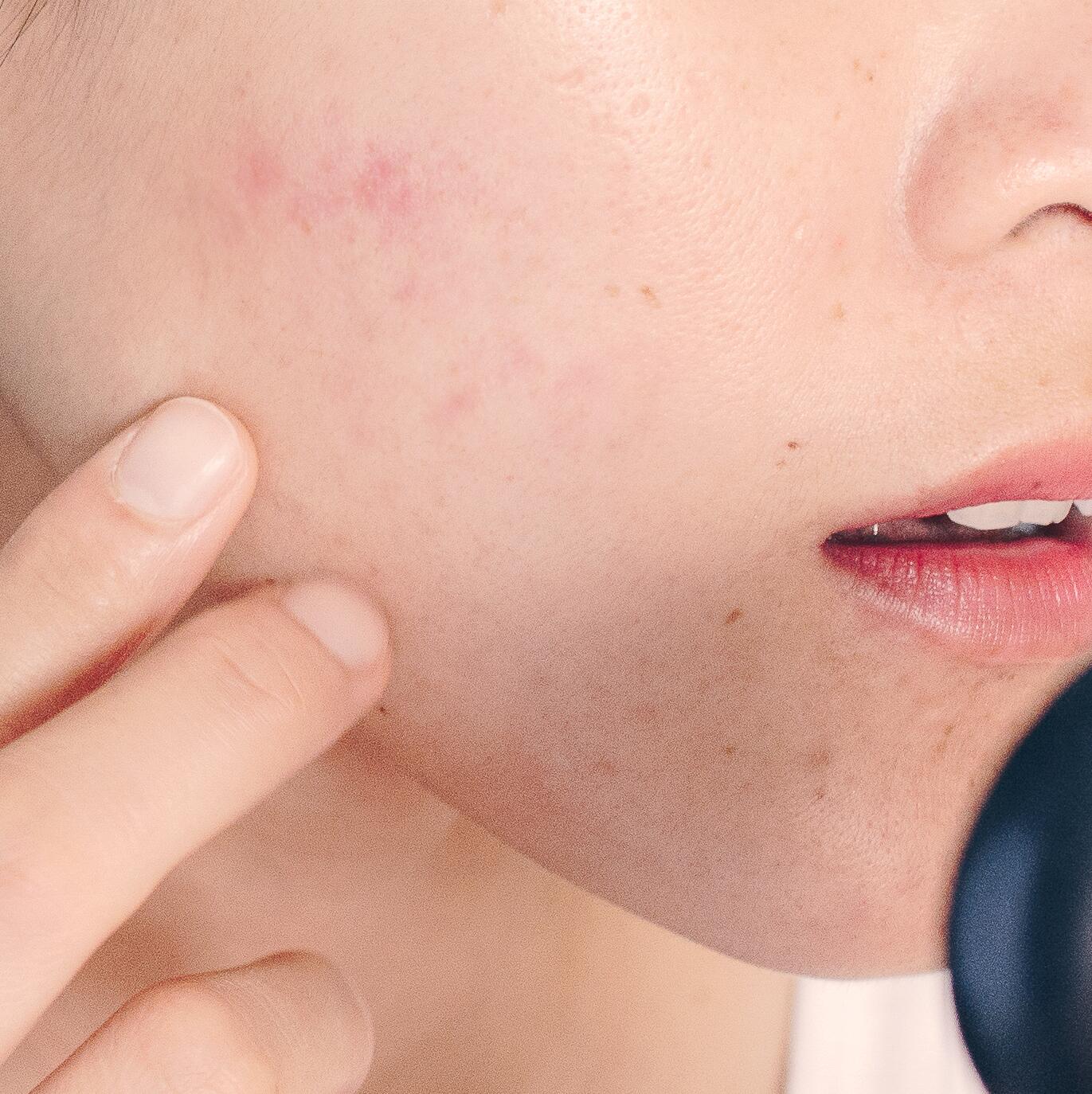 Des solutions ciblées pour atténuer vos cicatrices d’acné