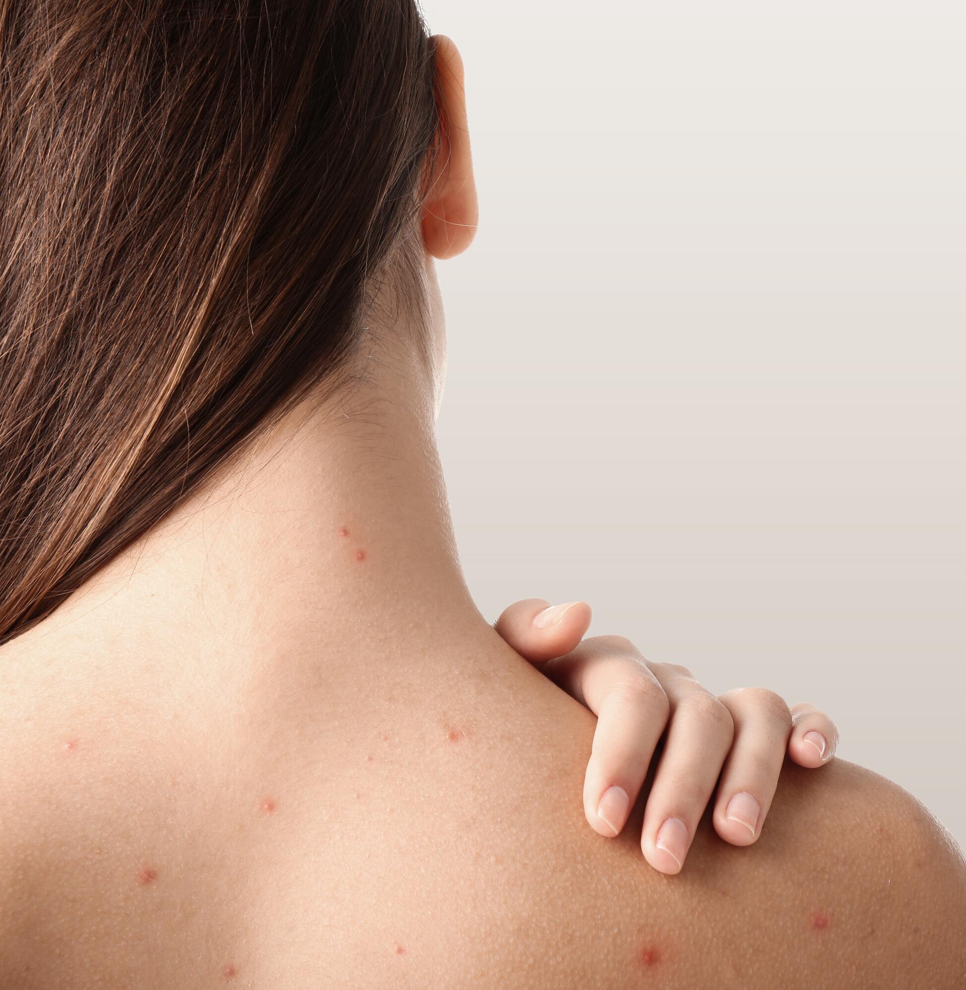 What is hormonal acne?