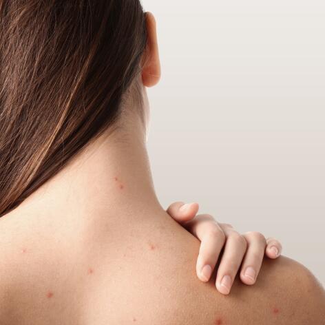 Qu'est-ce que l'acné hormonale ?