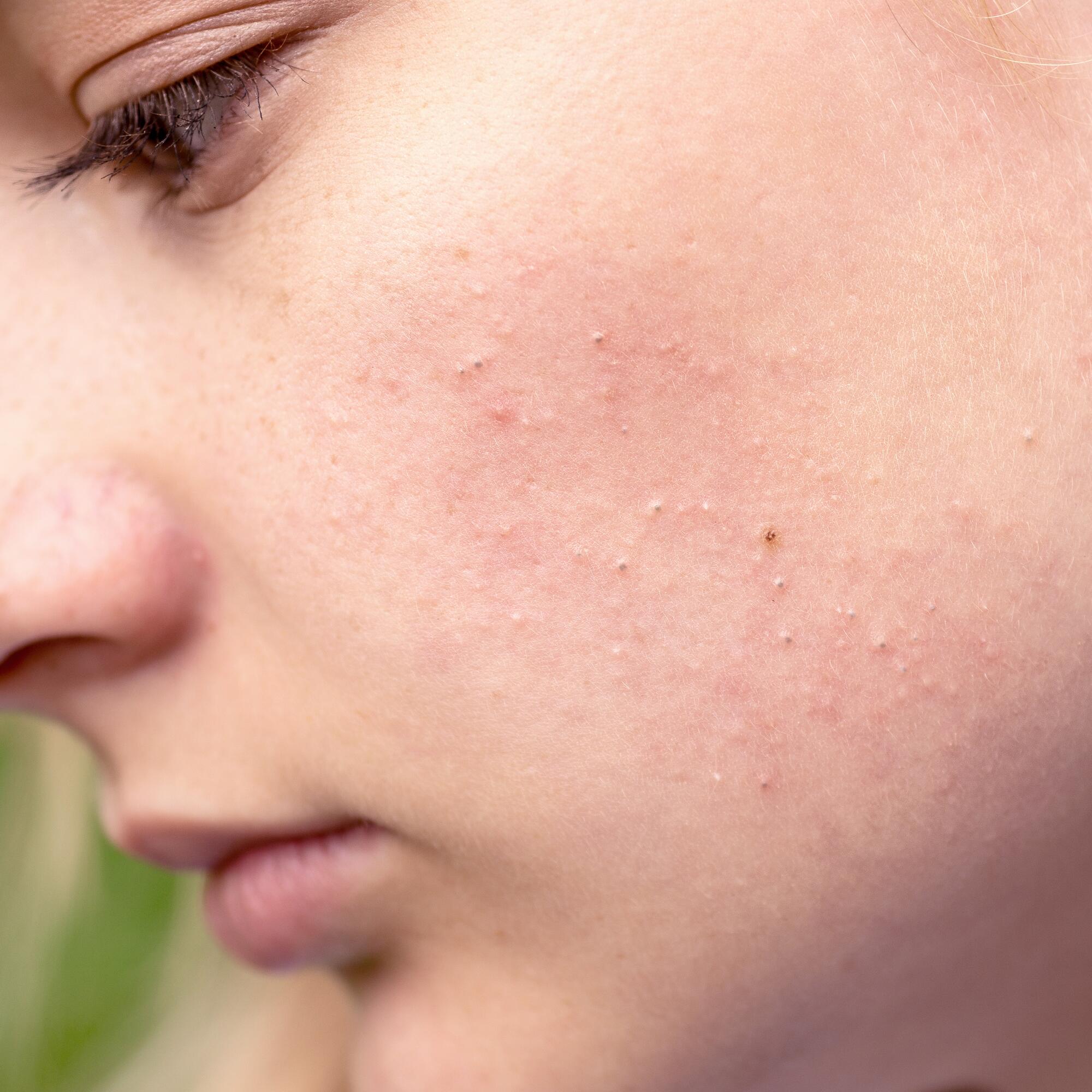Hormonal acne | Eau Thermale Avène