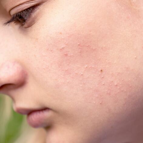 De verschillende stadia van hormonale acne ?