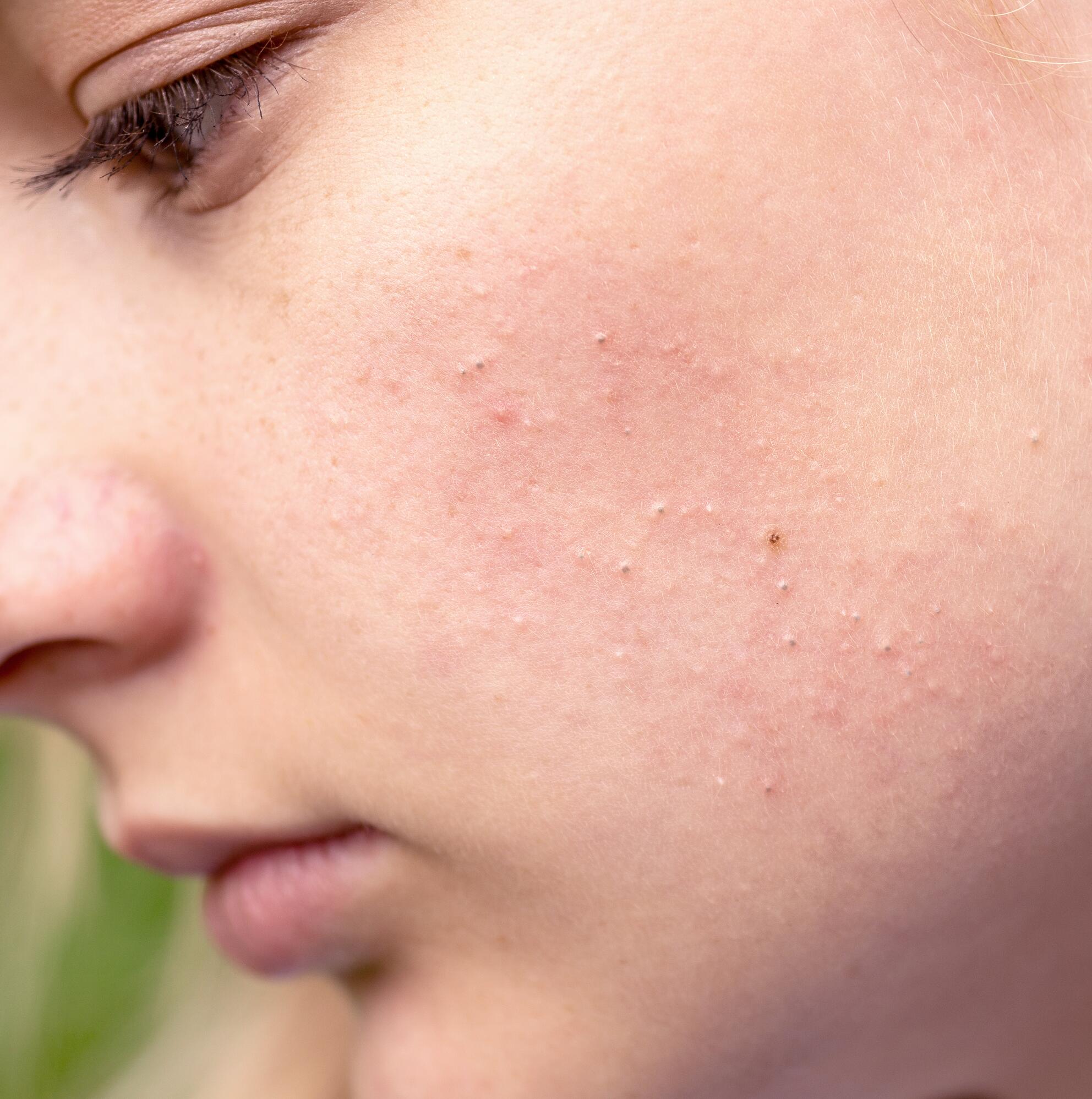 What are the different stages of hormonal acne?