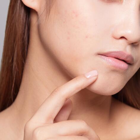 Les causes de l’acné
