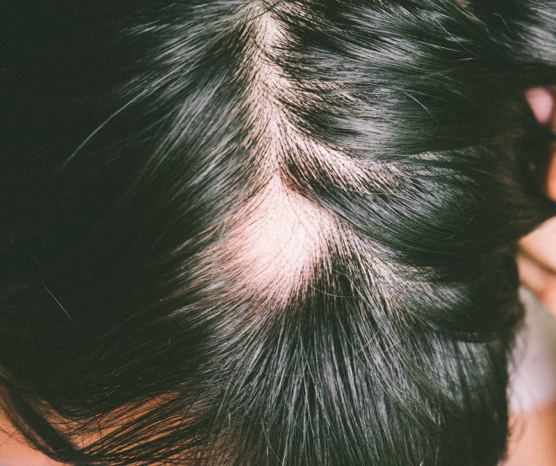 Chute de cheveux et pelade : symptômes et traitement | Ducray