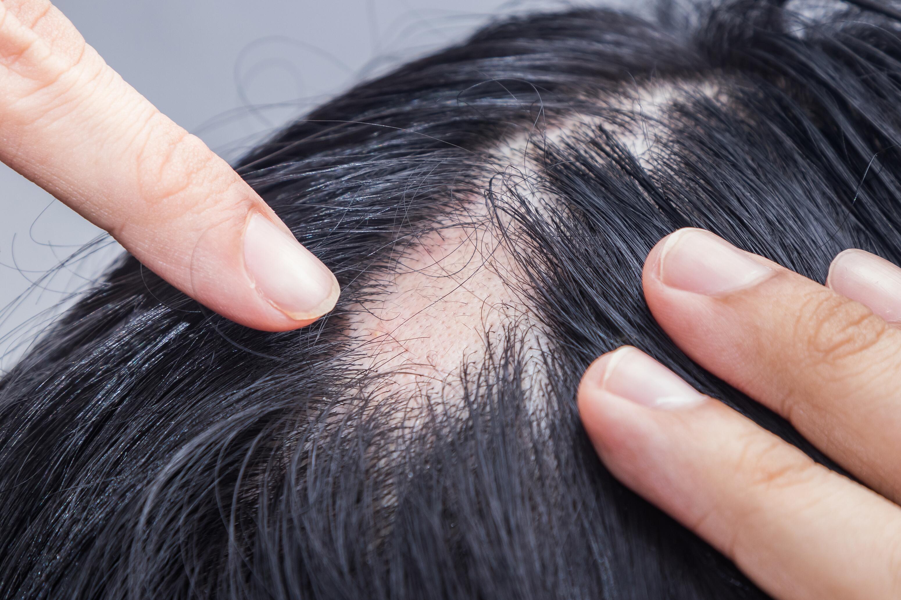 Alopecia cicatricial | Ducray