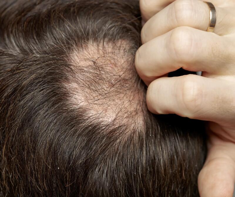 Chute de cheveux due à la syphilis secondaire : que faire ? | Ducray