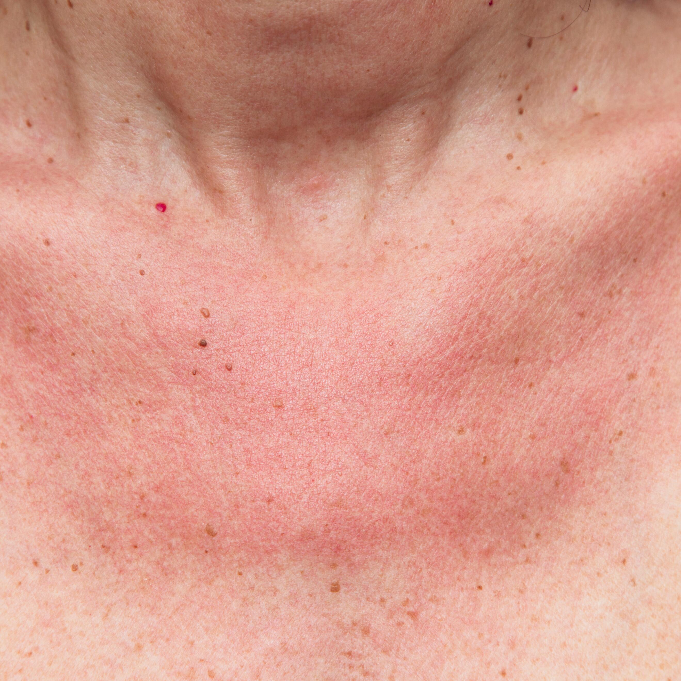 av_solaires_lucite_estival_1x1 473x473