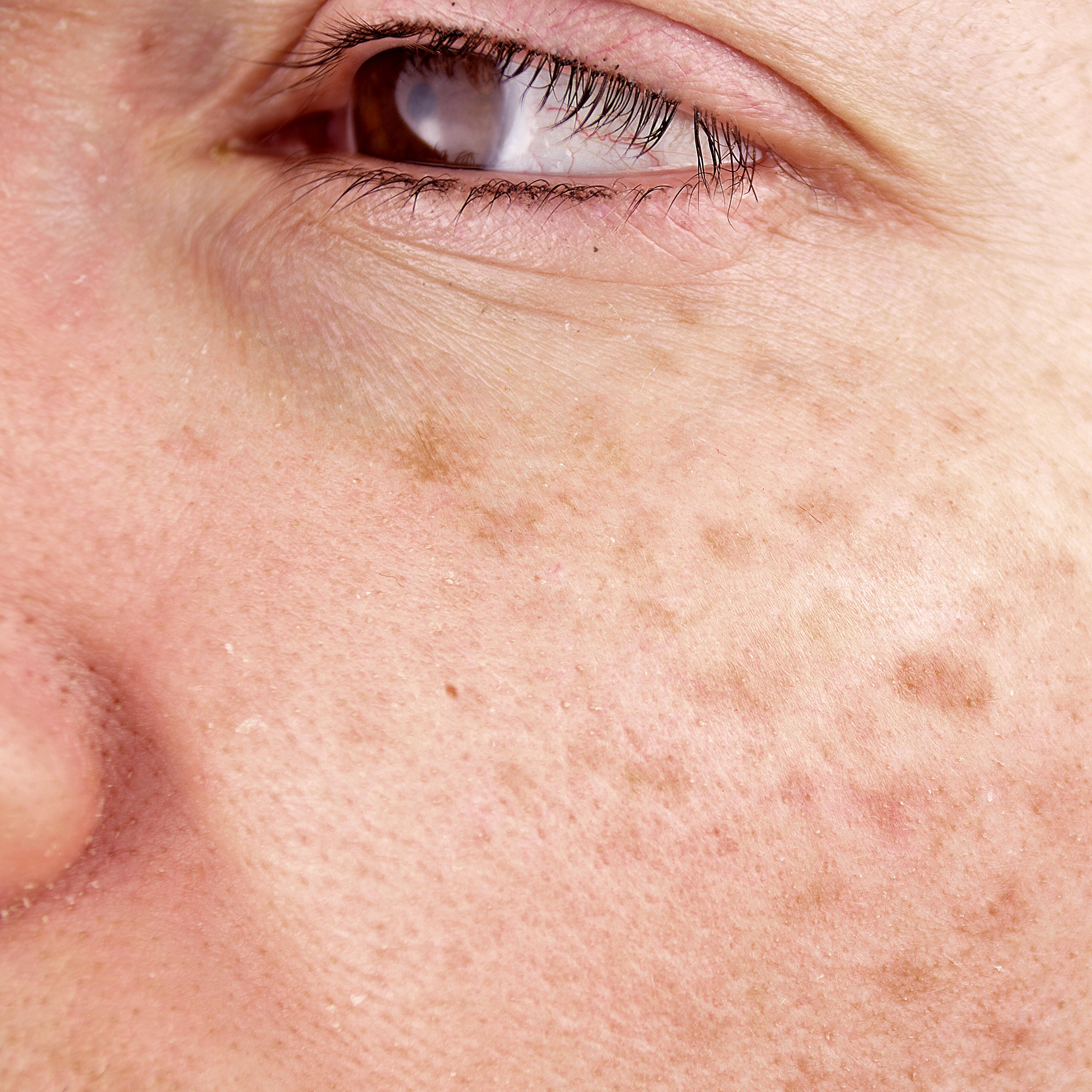 Taches brunes visage : causes, comment les atténuer