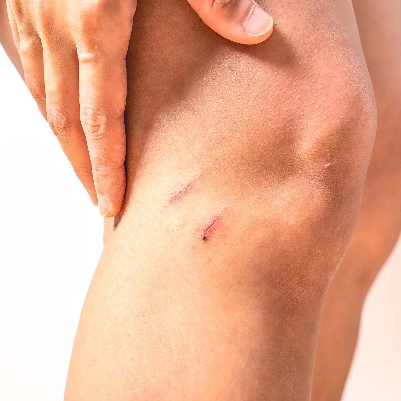 4 ideas erróneas sobre la cicatrización de heridas que deberías olvidar