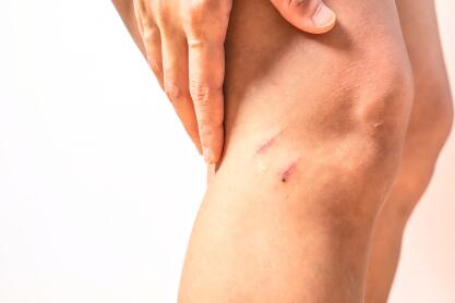 AD_SCARS_SCRATCH_KNEE_LARGE-1_2021