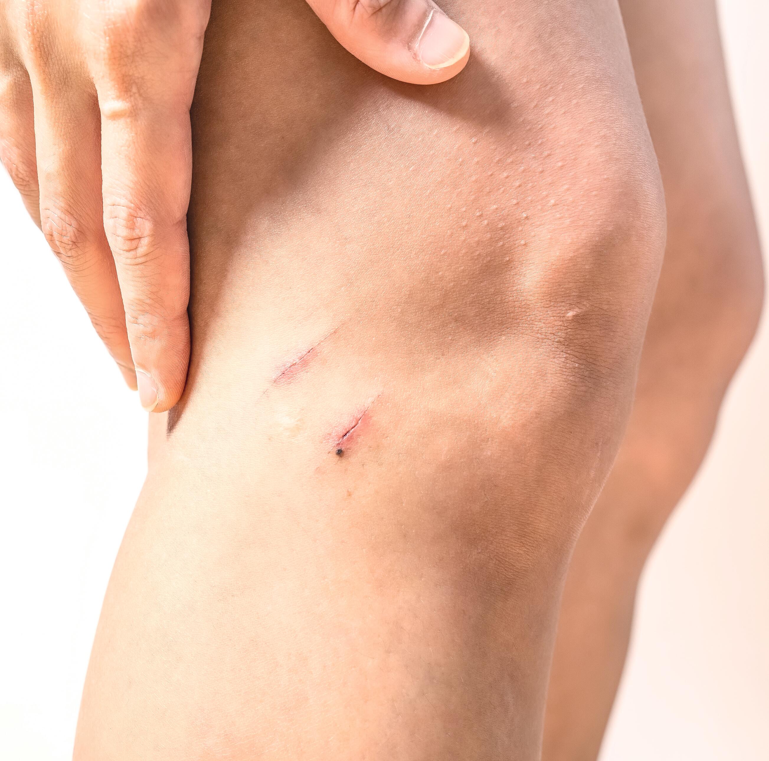 4 stereotiepe ideeën over wondgenezing die u beter niet gelooft