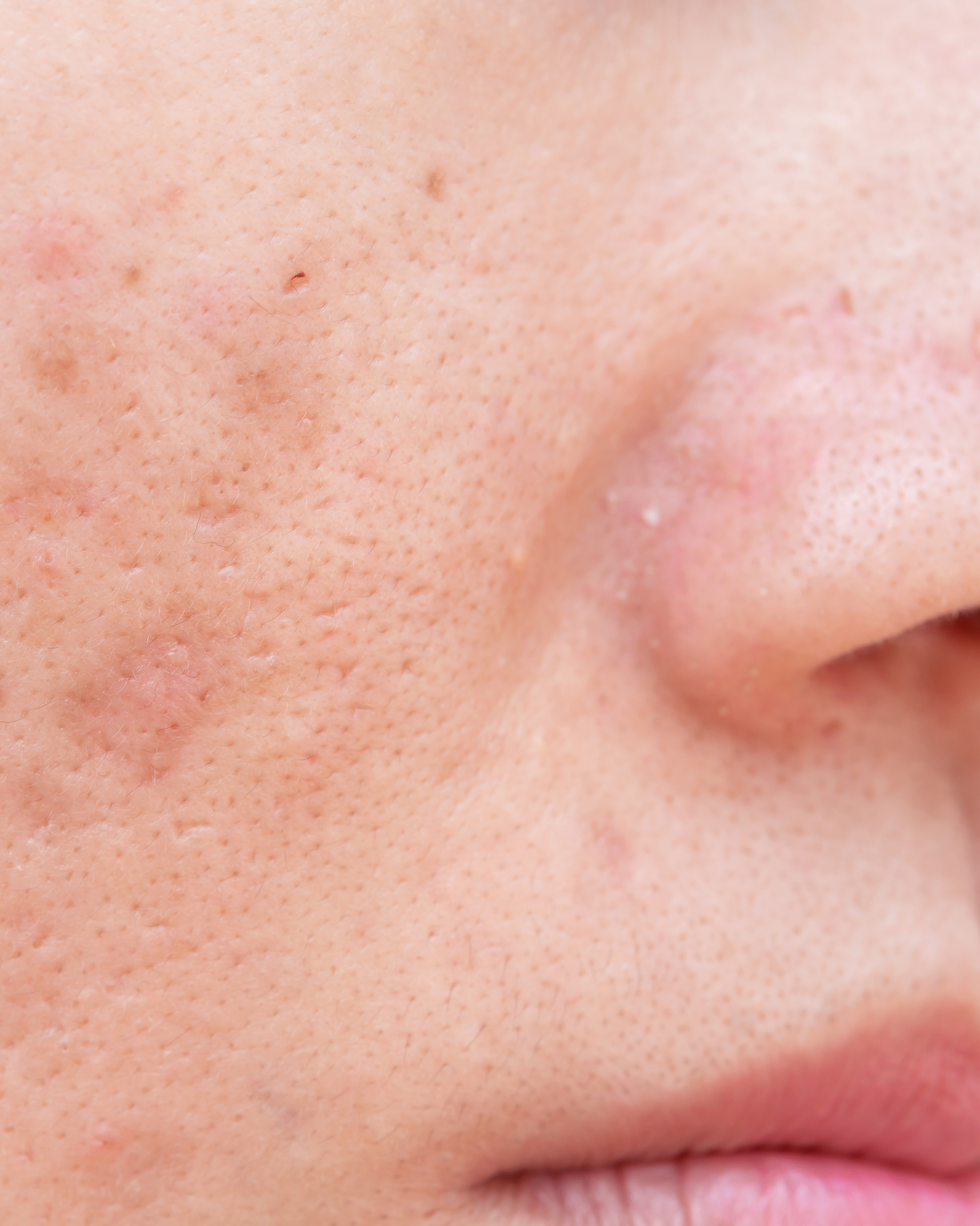 <span class="ezstring-field">av_votre-peau_cicatrisation_acne_4x5_368x460</span>