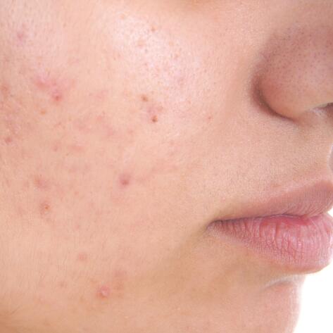 Cicatrici della pelle grassa a tendenza acneica