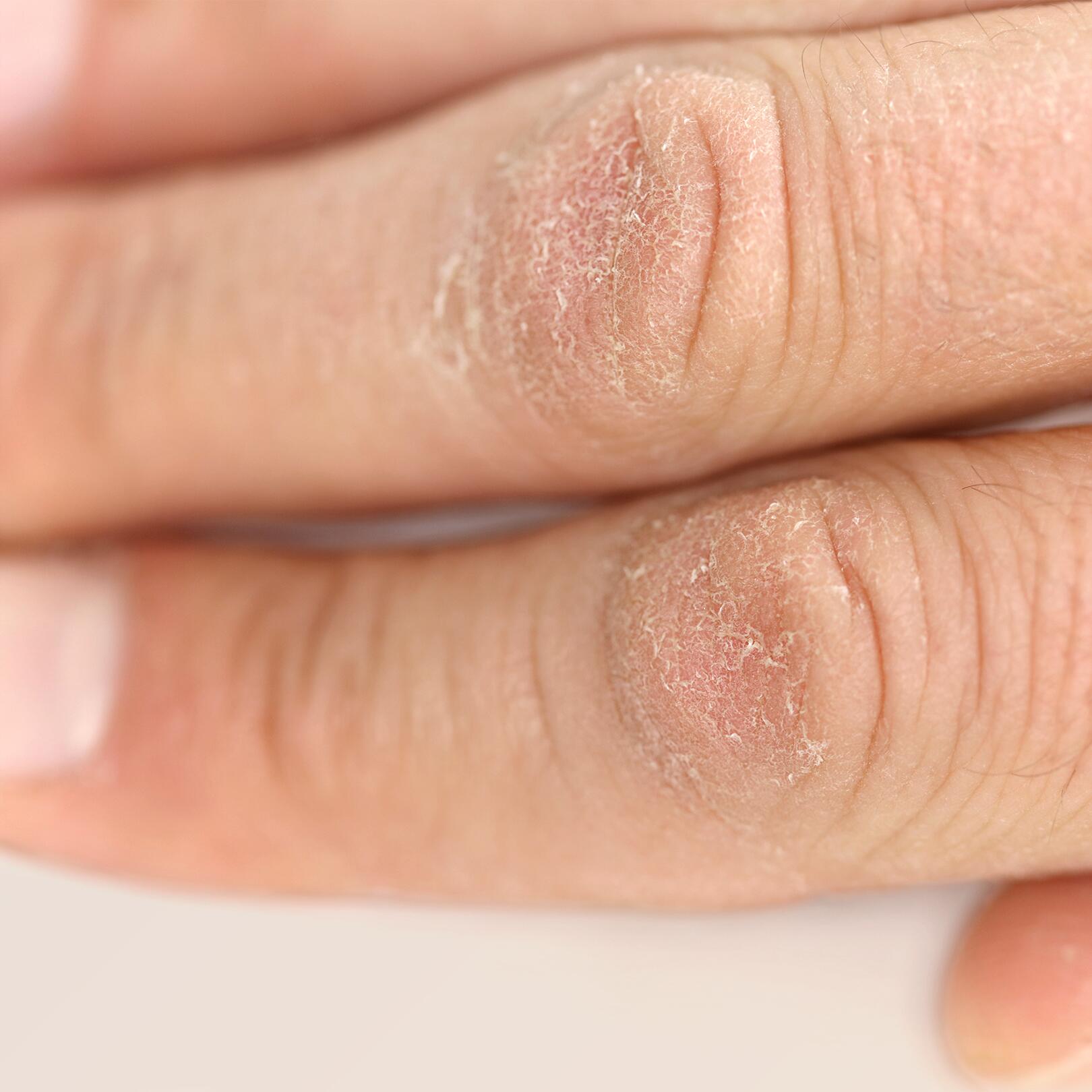 mover under Begyndelsen Hvordan genopbygger man tørre hænder? | Avène Termalkildevand