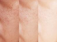 3 signes pour reconnaître une peau déshydratée