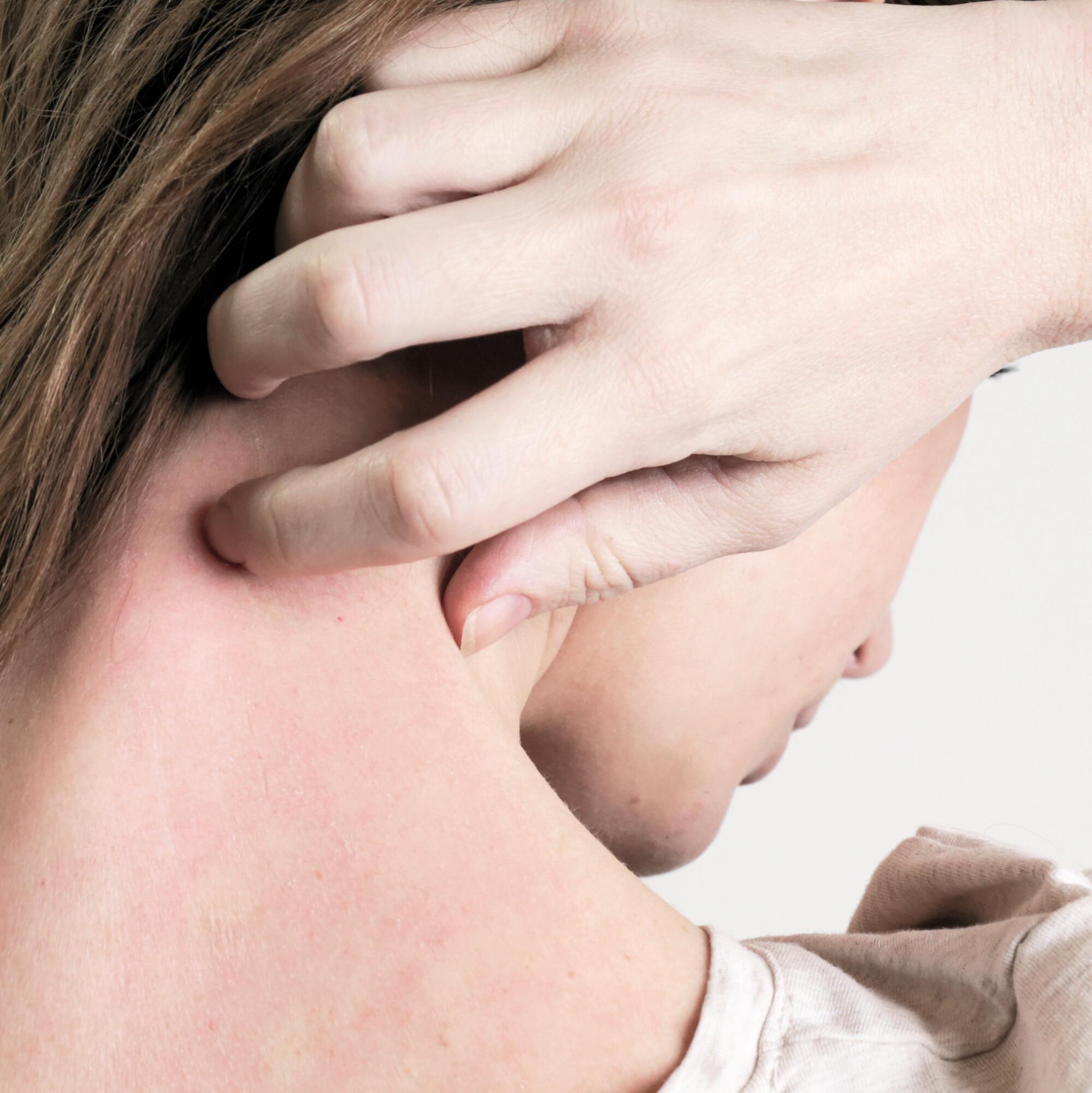 AD_ATOPIC-SKIN_WOMAN-SCRATCHING-ITCHING-NECK_SQUARE_2021