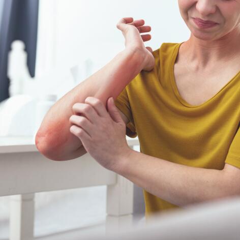Viver com pele com tendência para eczema: Eczema Conselhos e cuidados antiprurido