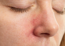 Seborrheic dermatitis and daily life