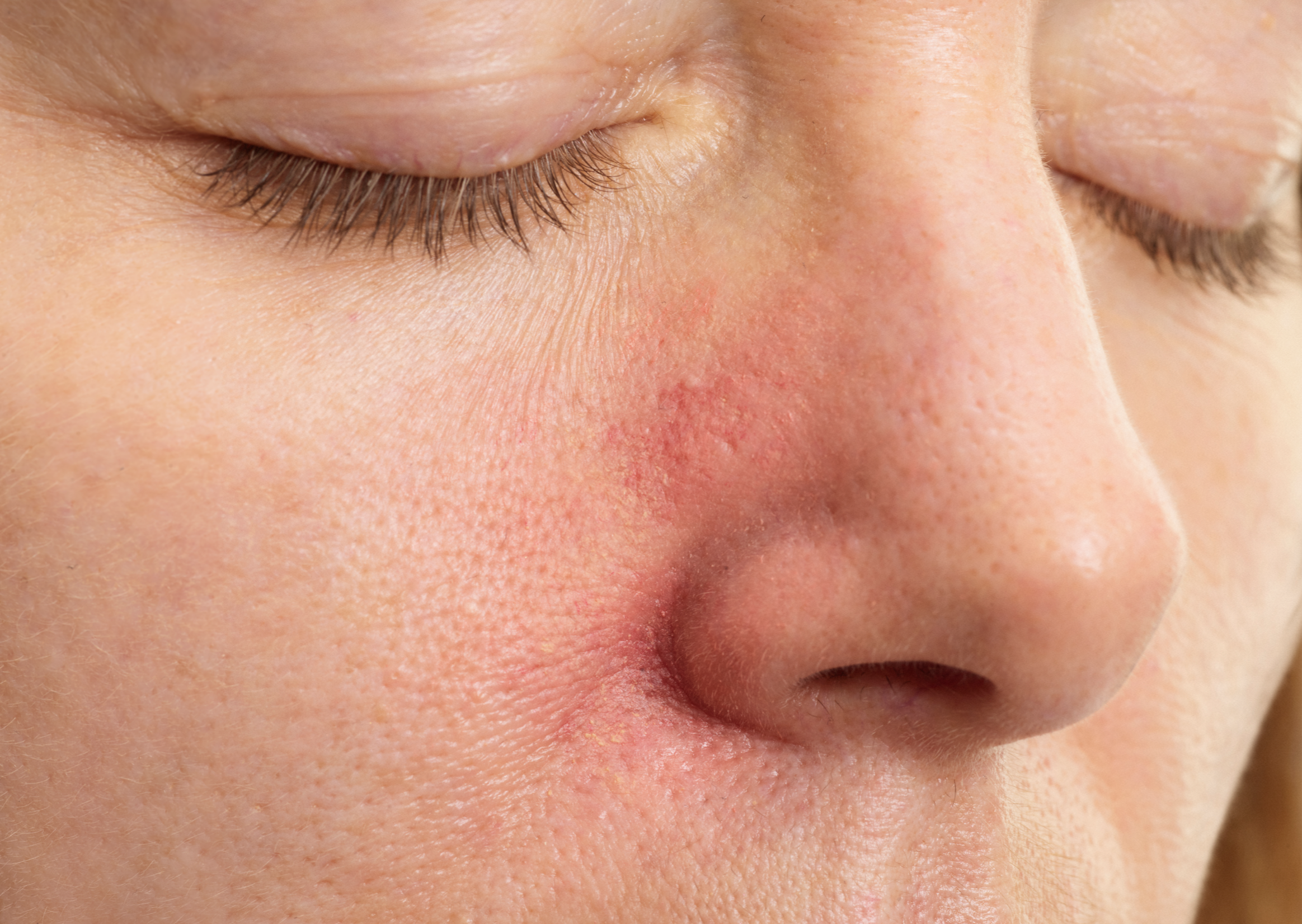 La dermatitis seborreica en la vida cotidiana