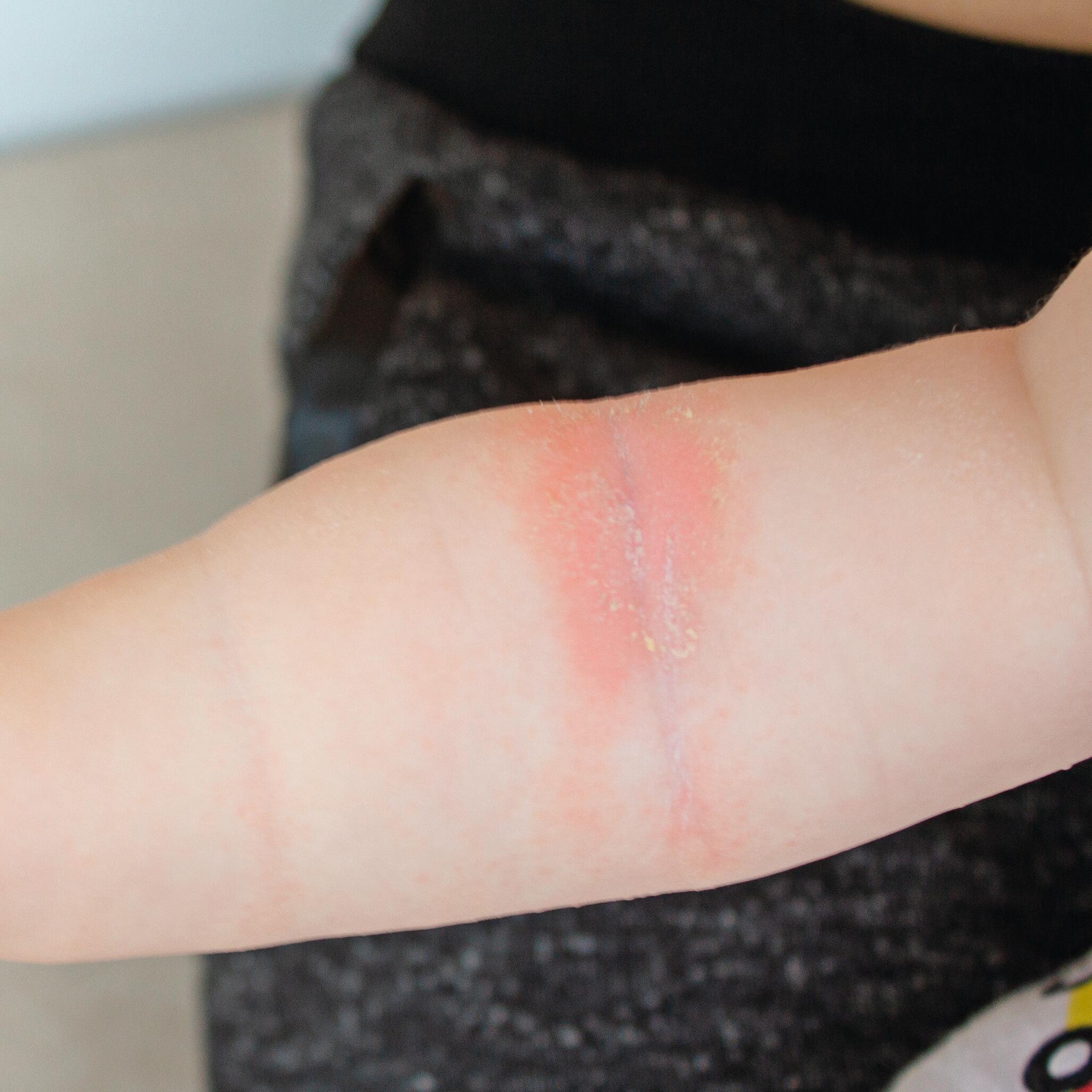 AD_ATOPIE_BABY-ARM_SQUARE_2021