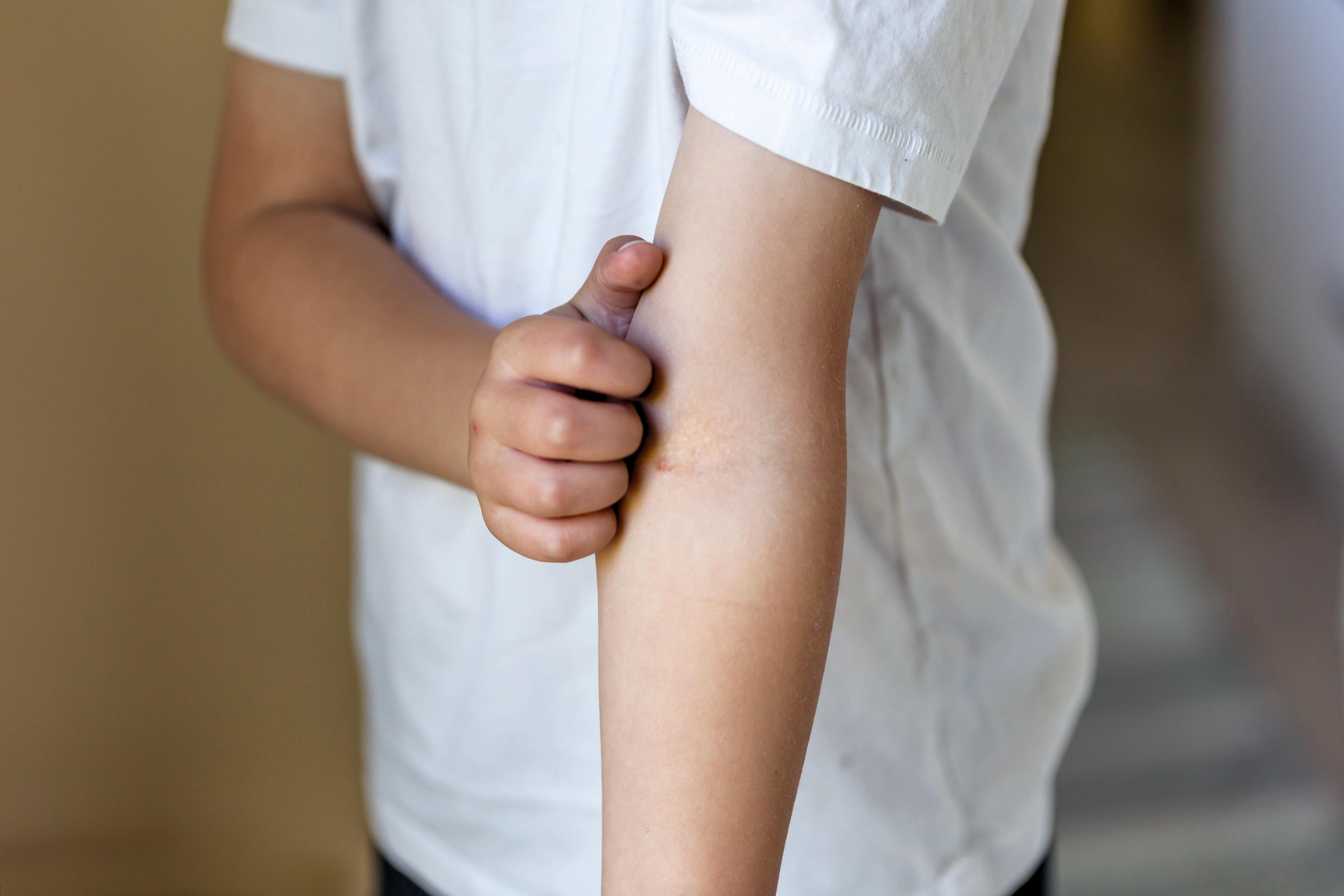 Eczema atópico: Aliviar o prurido
